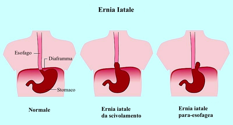 Como cerrar estomago